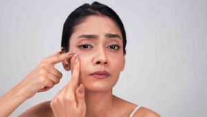 Bridal beauty tips: Keep these foods away to keep acne at bay before your big day