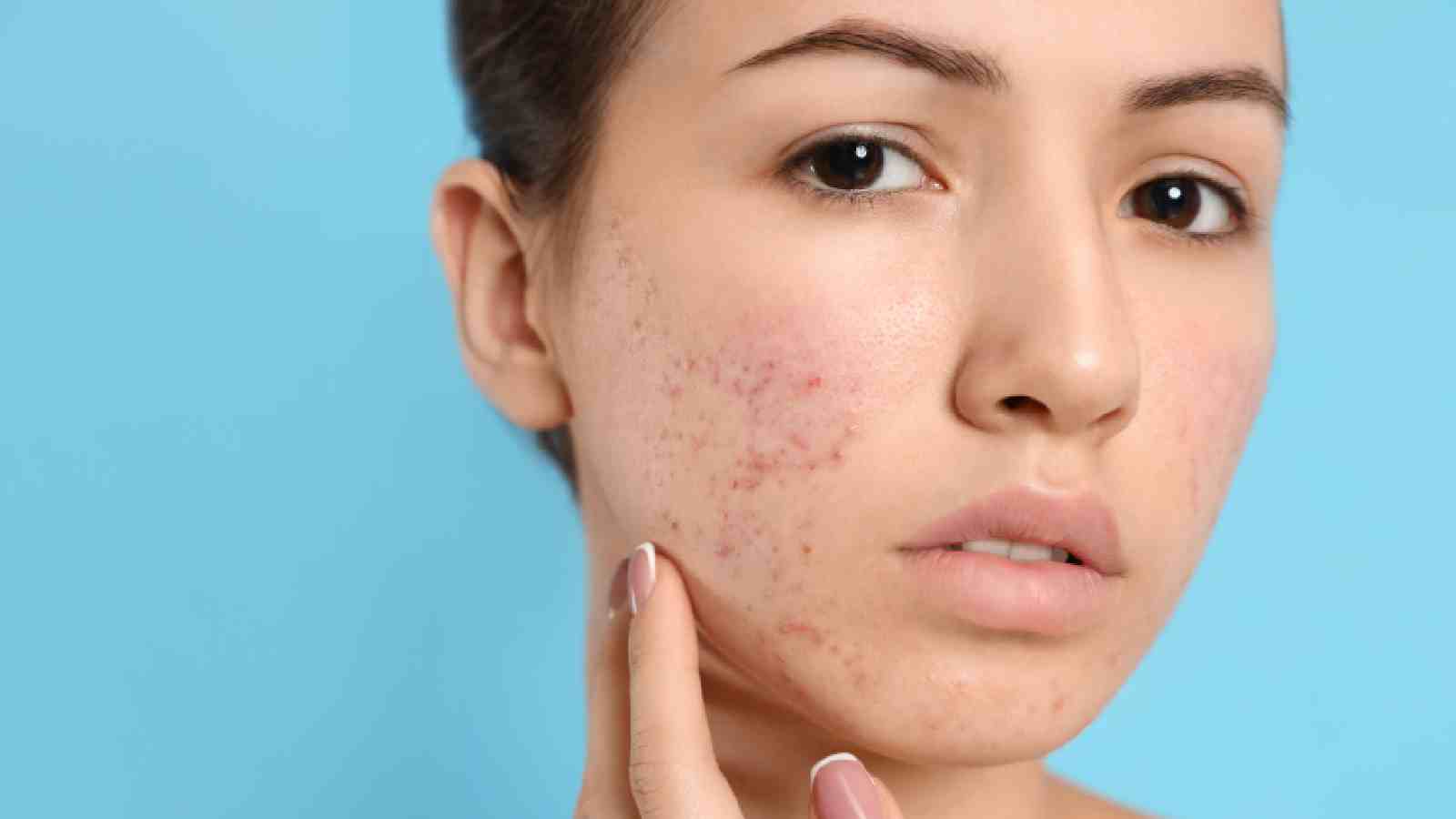 Anti-acne diet: 5 nutrients to combat acne and breakouts in monsoon